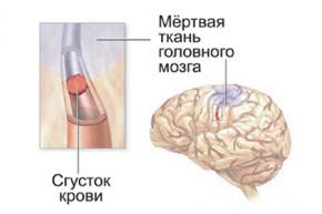 Самодиагностики инсульта
