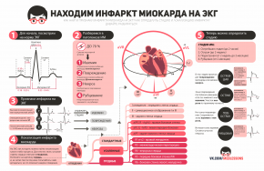 Инфаркт миокарда на ЭКГ