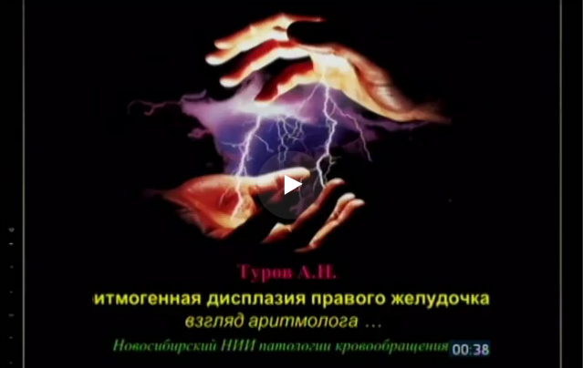 Аритмогенная дисплазия правого желудочка Аритмогенная дисплазия правого желудочка