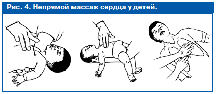 непрямой массаж сердца у детей непрямой массаж сердца у детей
