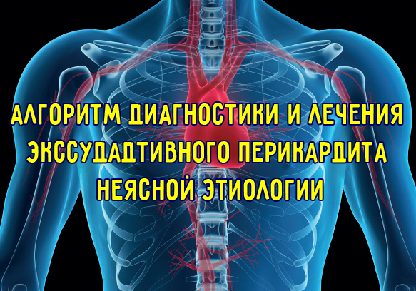 Алгоритм диагностики и лечения экссудадтивного перикардита неясной этиологии Алгоритм диагностики и лечения экссудадтивного перикардита неясной этиологии